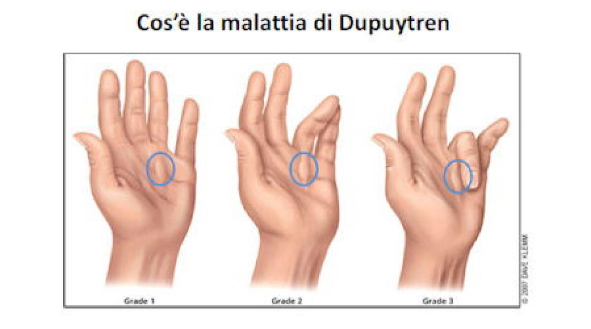 Malattia di Dupuytren corso di formazione al Valturio di Rimini -
