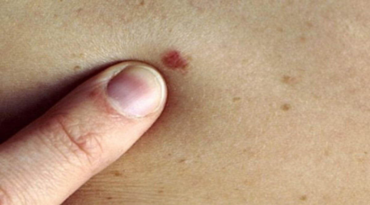 Video. Rimini, melanoma: in aumento i casi in Italia. Una rete per la prevenzione e l'informazione -