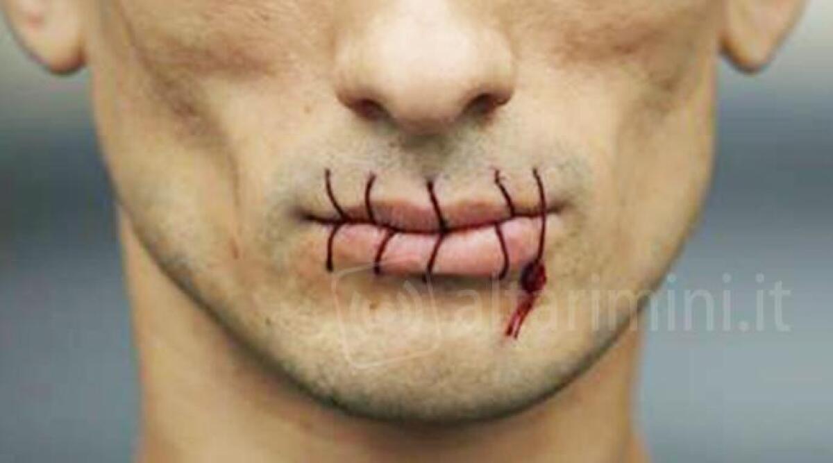 Si cuce la bocca con ago e filo, dramma per un detenuto nel carcere di Rimini - 