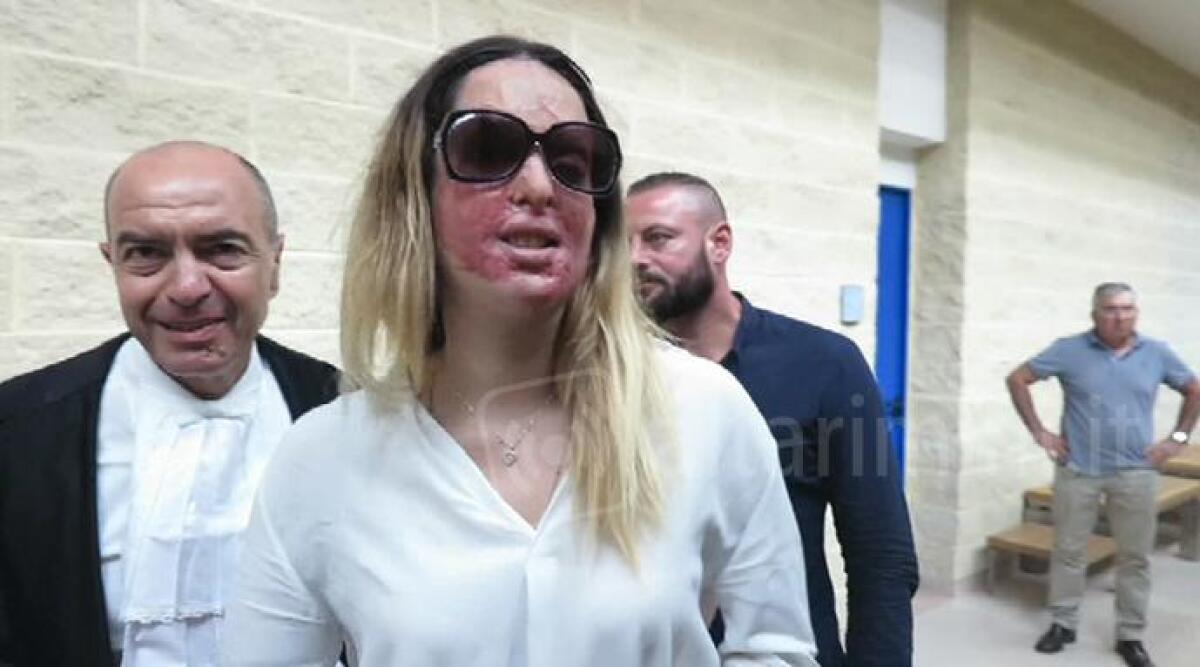 Sfregiata con acido: processo per Edison Tavares. Si decide il 22 settembre, in aula i due ex fidanzati - 