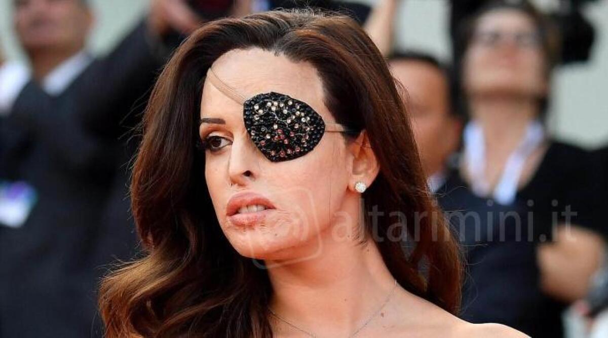 Sul palco di Sanremo anche Gessica Notaro, testimone contro la violenza sulle donne - 