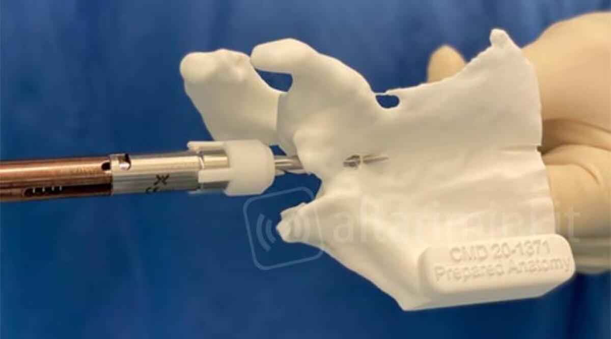Cattolica: una protesi fatta con stampante 3d salva la spalla di una paziente -