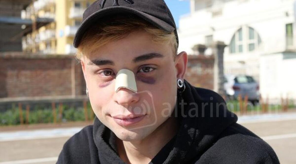 Gli spaccano il naso dopo aver baciato un ragazzo: aggredito in centro a Rimini - Filippo