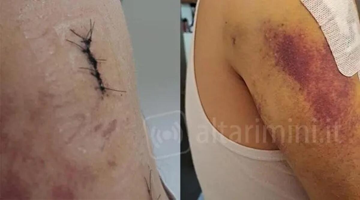 Accoltella il vicino a Villa Verucchio e lo sfregia: condannato a 2 anni e 8 mesi - Le ferite che riportò l'accoltellato