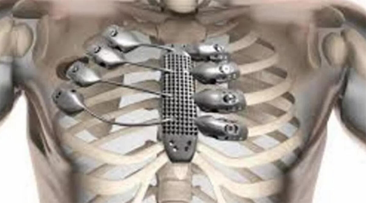 Torace e sterno creati in 3D su uomo 43enne con raro tumore - 