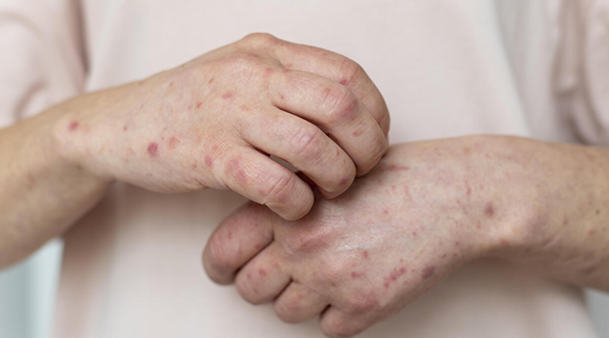 Aumento dei casi di morbillo: i pediatri lanciano un appello per il vaccino -