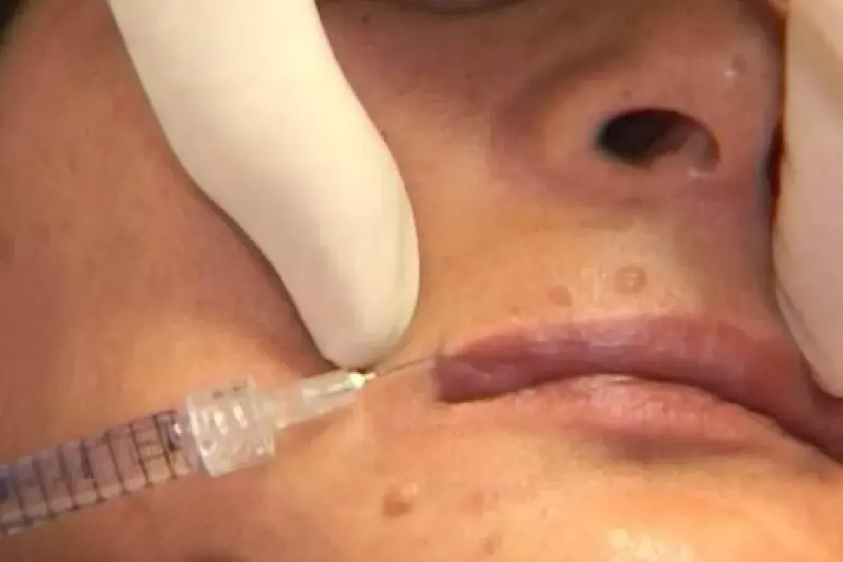 Pisa, muore dopo un’iniezione illegale per fini estetici - Una seduta estetica