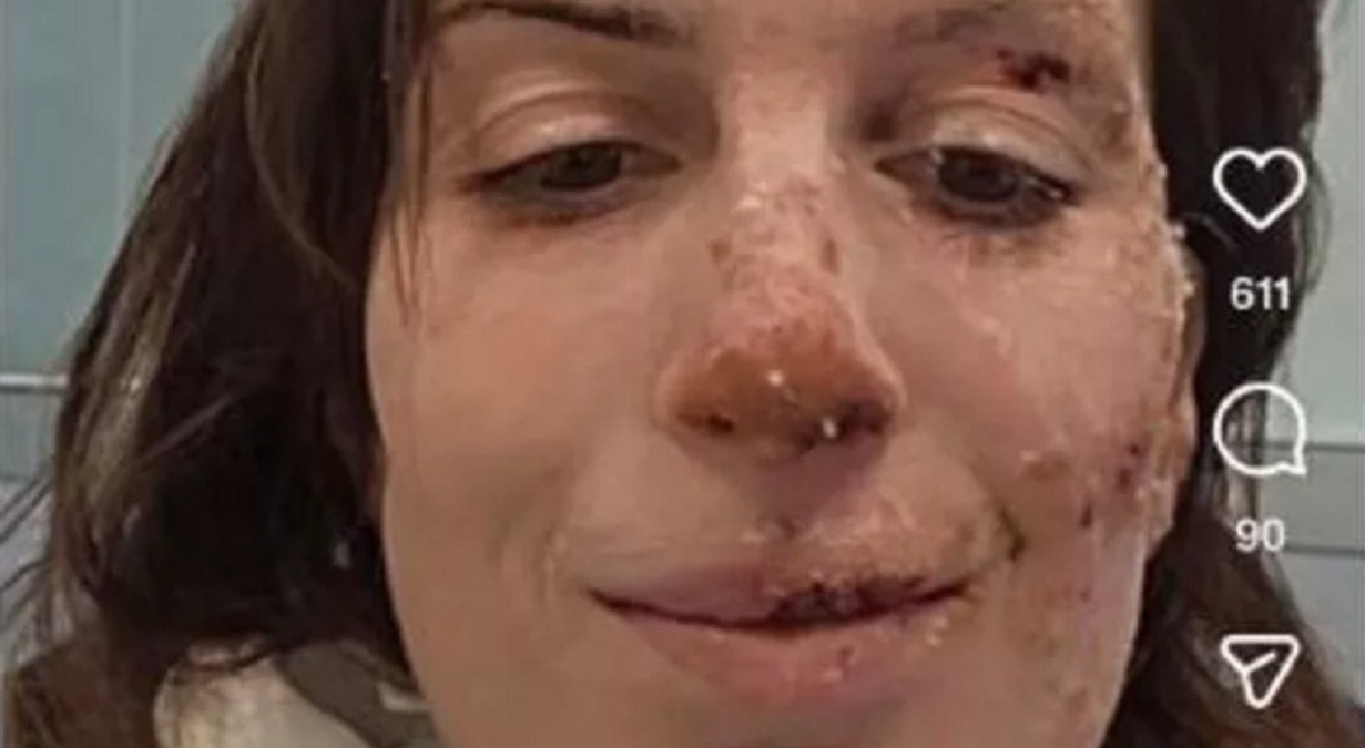 Crans Montana, Eleonora Palmieri mostra le ustioni sui social: "Onorate chi non c’è più" - Eleonora Palmieri mostra il volto ustionato sui social