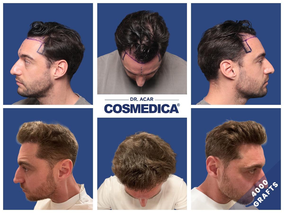 Trapianto capelli prima e dopo: aspetti importanti - 