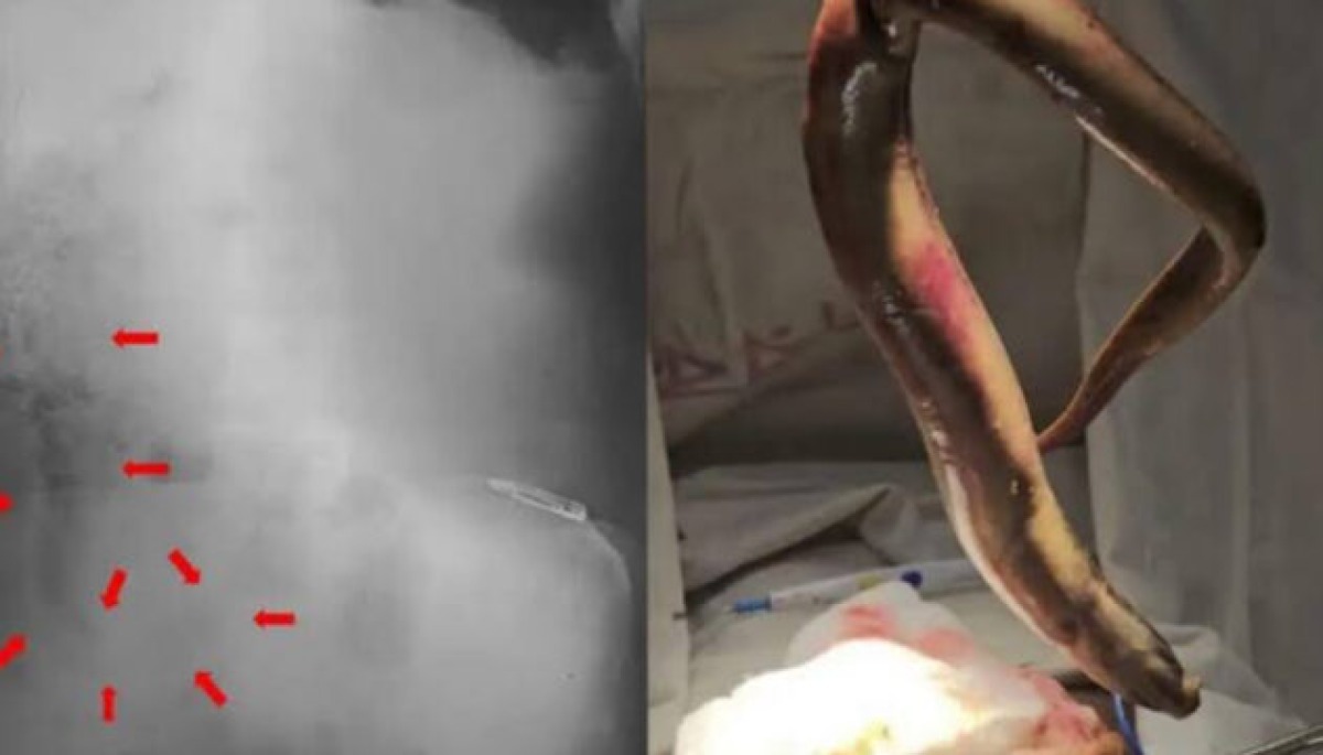 Ha dolori lancinanti, i medici gli trovano un'anguilla viva di 65 cm nell'addome - L'anguilla ancora viva estratta dall'intestino. Credit: Mokbul et al., Int. J. Surg. Case Rep., 2026