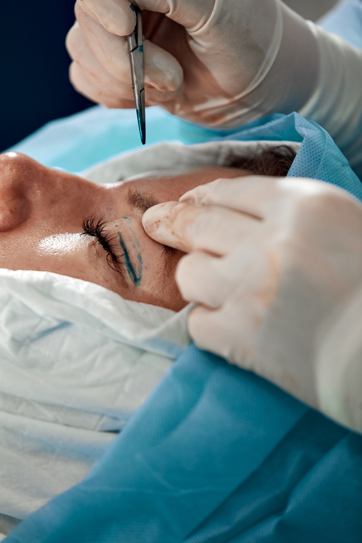Lifting da incubo, necrosi e cicatrici: risarcita con oltre 50mila euro - Repertorio